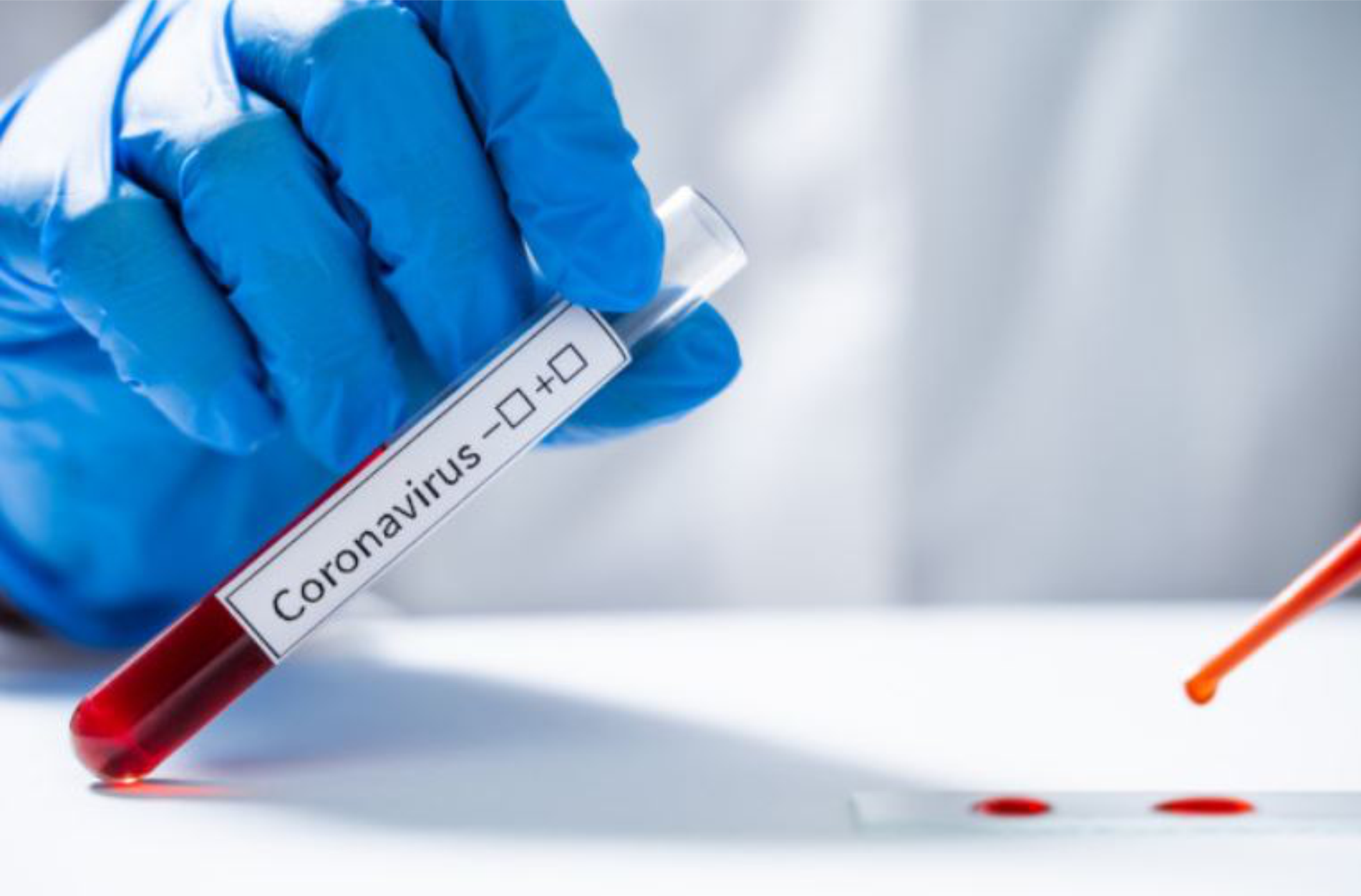 “Zeytun Pharmaceuticals” MMC COVID-19 virusunun müayinəsi üçün Səhiyyə Nazirliyinə təmənnasız 50 000 PZR test dəsti təqdim etdi